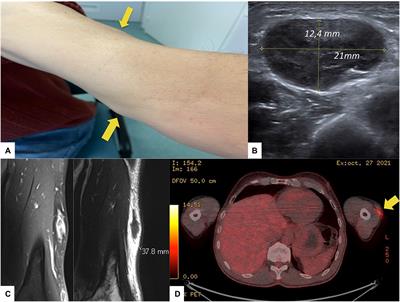 Insulin amyloidosis: A case report